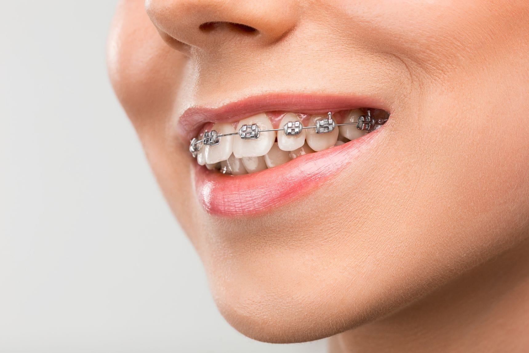 Braces in Brewton